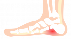 Plantar-Fasciitis