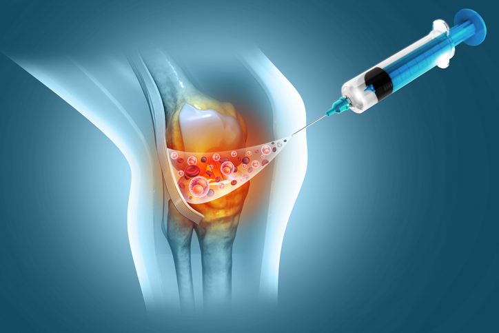 Corticosteroid Injections in Musculoskeletal Care: Current Research and Clinical Considerations